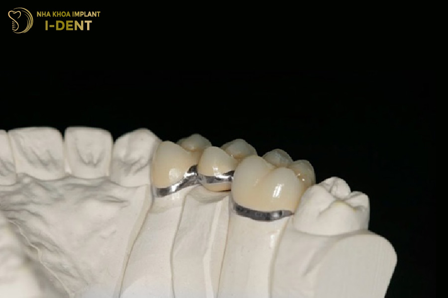 Răng sứ Titan có trọng lượng nhẹ và thẩm mỹ khá tự nhiên tác hại của răng sứ kim loại