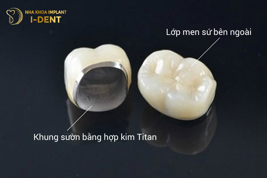 Răng sứ kim loại có khả năng chịu lực nhai tốt Răng sứ kim loại có khả năng chịu lực nhai tốt