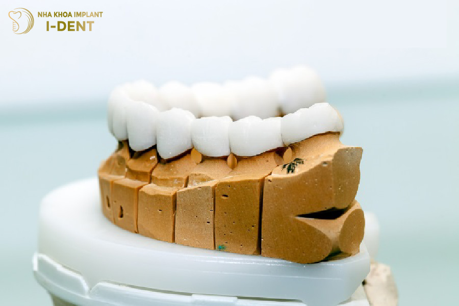 Răng sứ Vita có khả năng chống đứt gãy tốt Răng sứ Vita có khả năng chống đứt gãy tốt