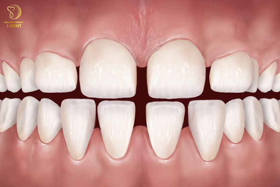 Trường hợp răng cửa bị thưa Trường hợp răng cửa bị thưa
