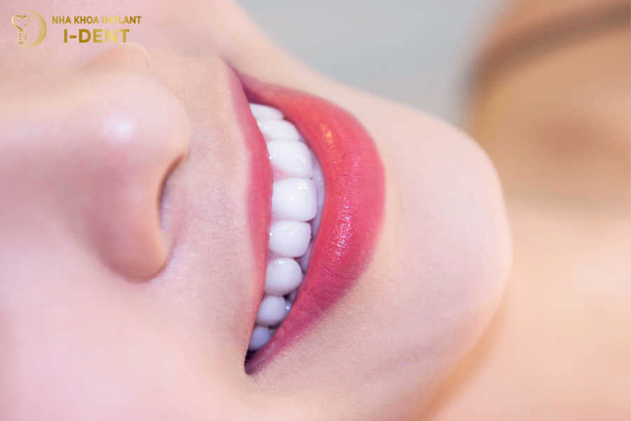 Răng toàn sứ có giá trị thẩm mỹ rất cao