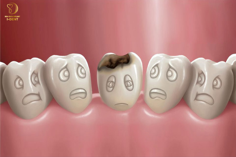 Sâu răng cần phải trám ngay để tránh nặng thêm và gây hại cho những răng khác
