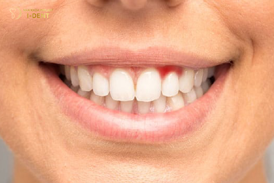Sử dụng răng sứ kém chất lượng gây ra tình trạng viêm nướu răng Sử dụng răng sứ kém chất lượng gây ra tình trạng viêm nướu răng
