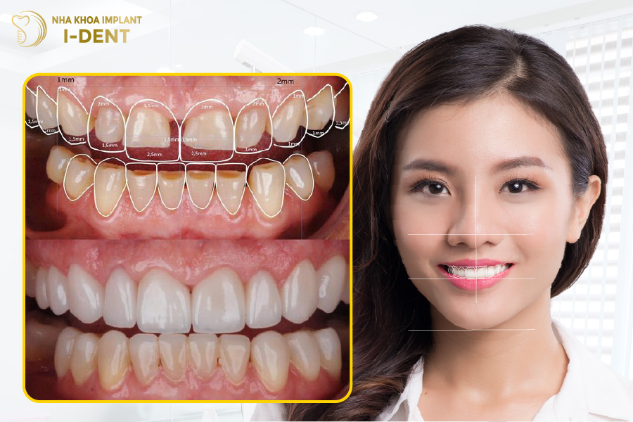 Tỉ lệ mài cùi răng đúng chuẩn Tỉ lệ mài cùi răng đúng chuẩn