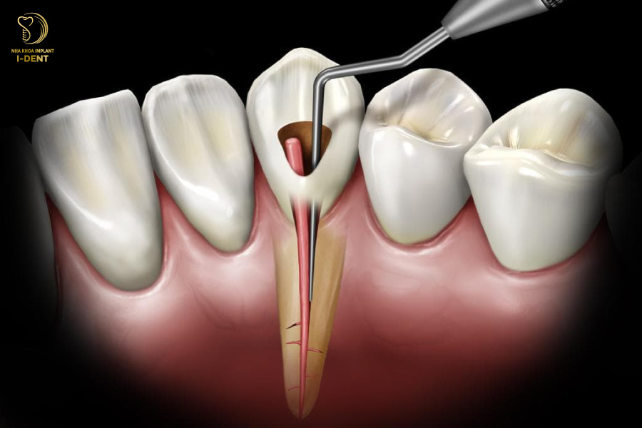 quy trình diều trị tủy răng quy trình diều trị tủy răng