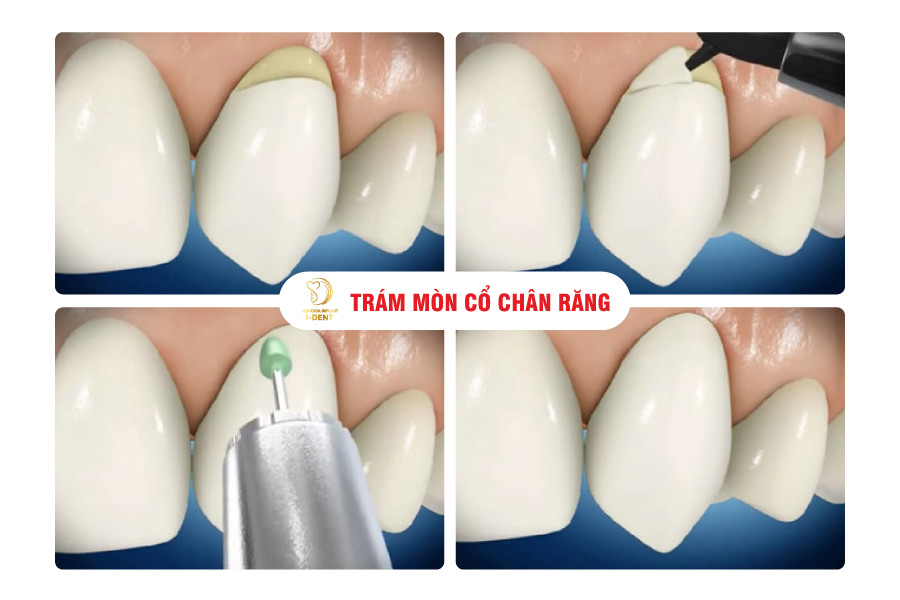 Trám cổ chân răng là cách để phục hình răng đơn giản và hiệu quả nhất Trám cổ chân răng là cách để phục hình răng đơn giản và hiệu quả nhất