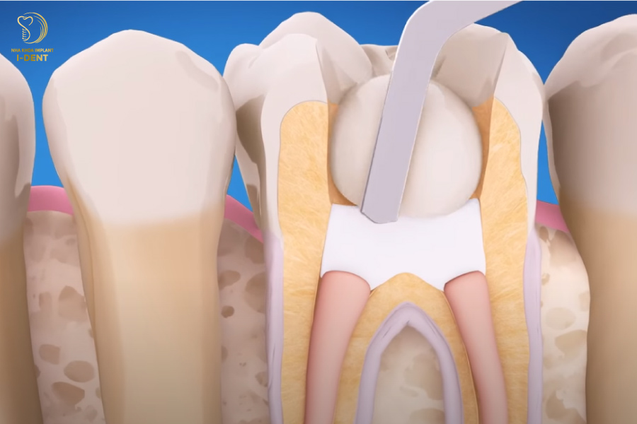 quy trình diều trị tủy răng quy trình diều trị tủy răng