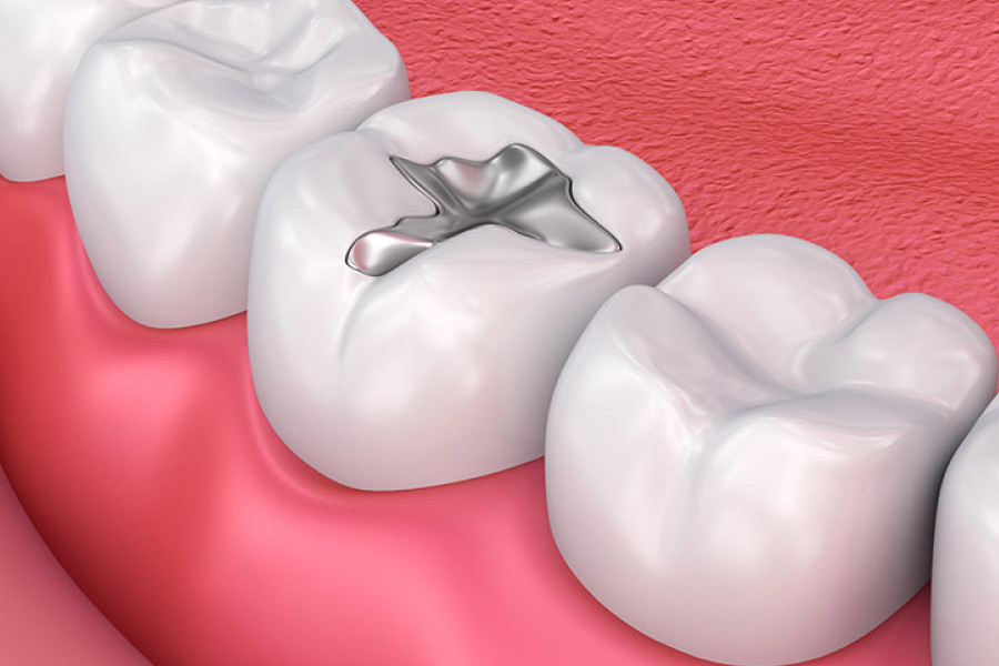 Trám răng bằng Amalgam chỉ có thể sử dụng cho răng hàm, không thể dùng cho răng cửa Trám răng bằng Amalgam chỉ có thể sử dụng cho răng hàm, không thể dùng cho răng cửa