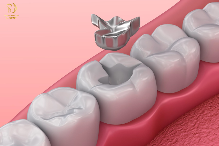 Hàn răng bằng Amalgam có khả năng phục hình hiệu quả, đặc biệt là những trường hợp răng sứt mẻ, gãy vỡ lớn Hàn răng bằng Amalgam có khả năng phục hình hiệu quả, đặc biệt là những trường hợp răng sứt mẻ, gãy vỡ lớn