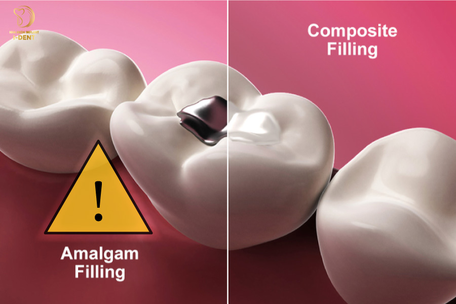 Trám răng bằng Amalgam Trám răng bằng Amalgam