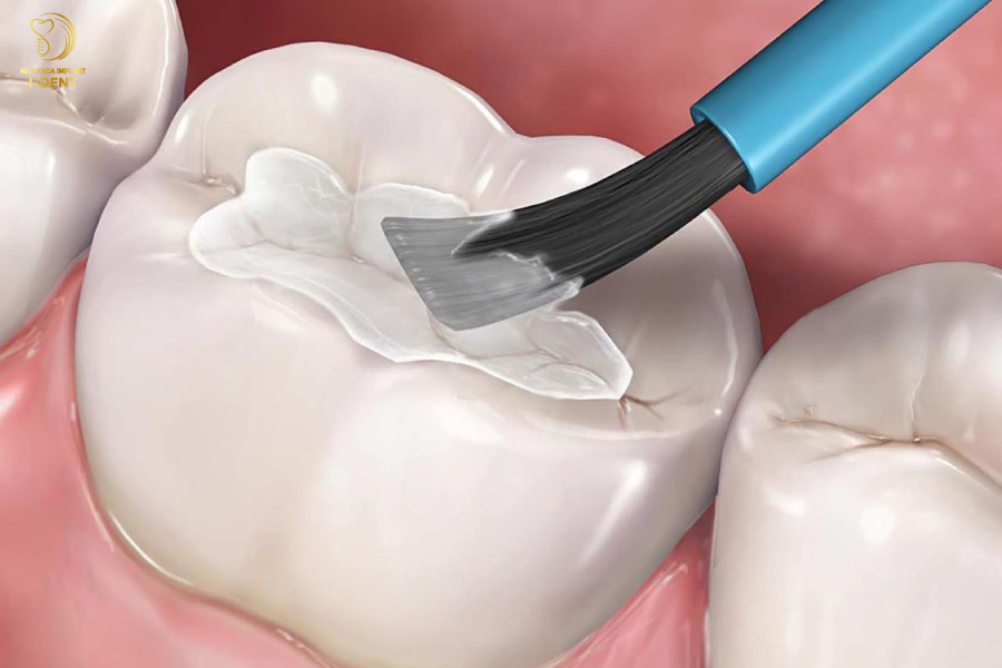 Trám răng bằng GIC có màu trắng bột, gần giống với màu răng thật Trám răng bằng GIC có màu trắng bột, gần giống với màu răng thật