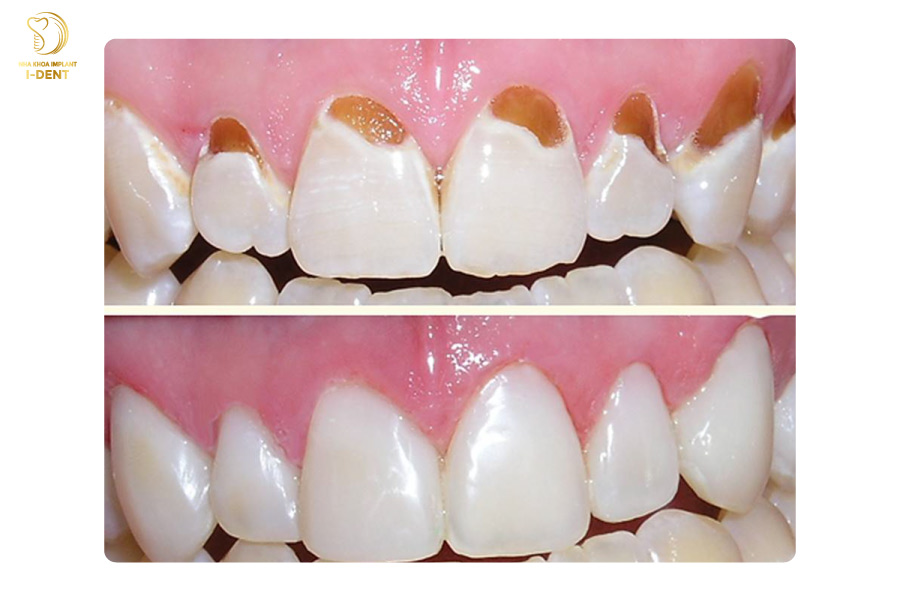 Trám răng GIC khi cổ chân răng bị mòn Trám răng GIC khi cổ chân răng bị mòn
