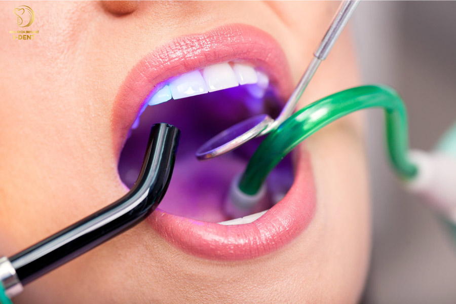 Trám răng có kỹ thuật đơn giản, không sưng đau và có thể sử dụng lâu dài