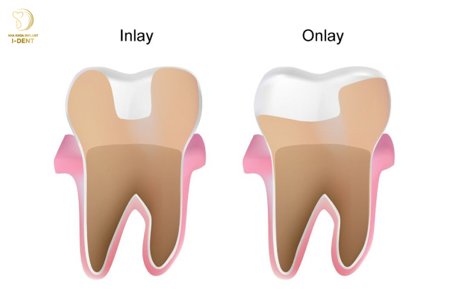 Trám răng Inlay Onlay là gì? Trám răng Inlay Onlay là gì?