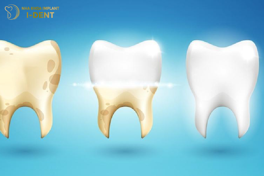 Tráng men răng giúp bảo vệ răng khỏi sâu và cải thiện màu sắc răng Tráng men răng giúp bảo vệ răng khỏi sâu và cải thiện màu sắc răng