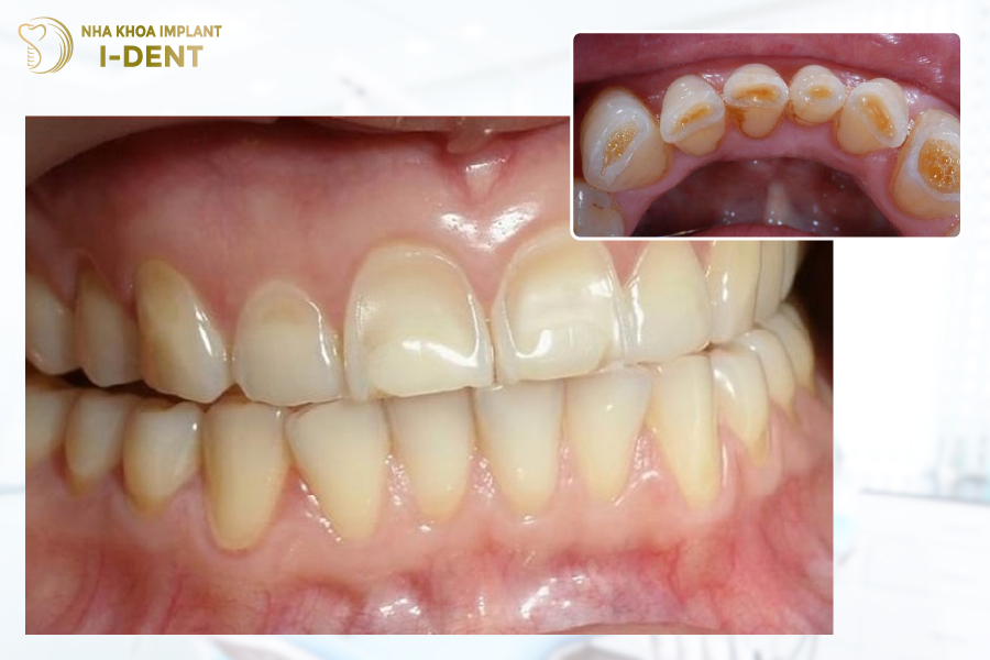 Tráng men răng là giải pháp cho những người bị mòn men răng Tráng men răng là giải pháp cho những người bị mòn men răng