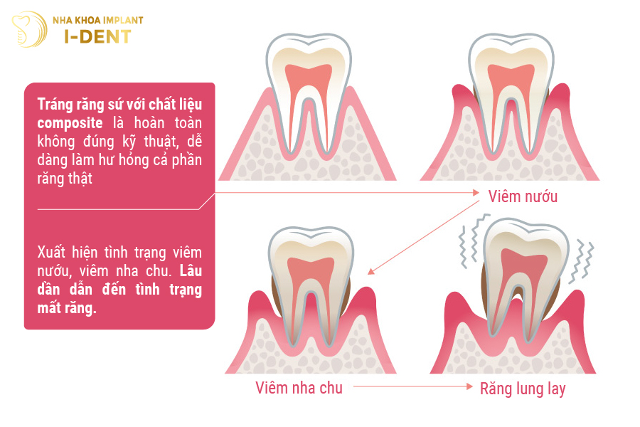 Tráng răng sứ ở cơ sở không uy tín có thể gây mất răng Tráng răng sứ ở cơ sở không uy tín có thể gây mất răng