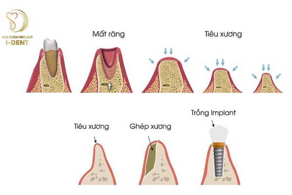 Làm răng giả tránh tình trạng tiêu xương Làm răng giả tránh tình trạng tiêu xương