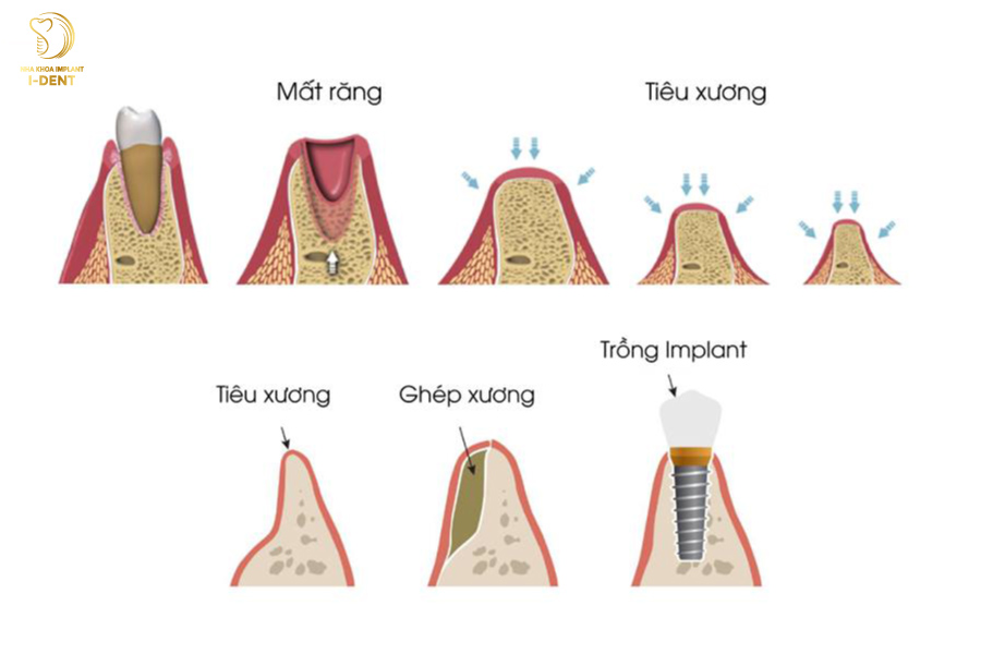 Ngăn ngừa tình trạng tiêu xương Ngăn ngừa tình trạng tiêu xương