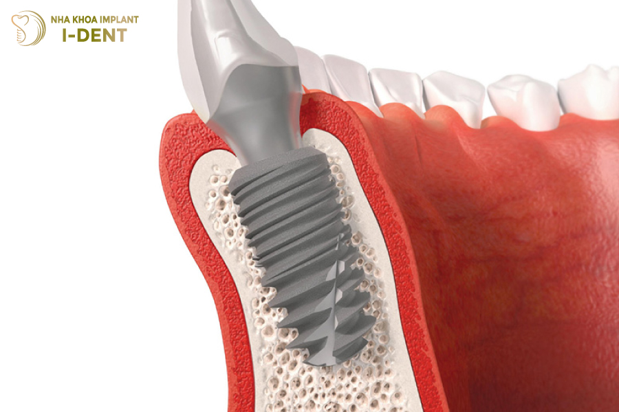 Trồng răng implant khác phục được tình trạng tiêu xương hàm Trồng răng implant khác phục được tình trạng tiêu xương hàm