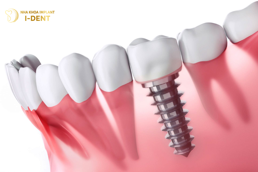 Trồng răng implant là phương án tối ưu nhất hiện nay Trồng răng implant là phương án tối ưu nhất hiện nay