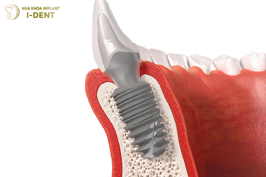 Trụ Implant lành tính, dễ dàng tích hợp với xương hàm Trụ Implant lành tính, dễ dàng tích hợp với xương hàm