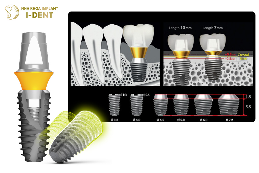 Trụ Implant Mỹ có công nghệ xử lý vùng cổ Implant khác nhau Trụ Implant Mỹ có công nghệ xử lý vùng cổ Implant khác nhau