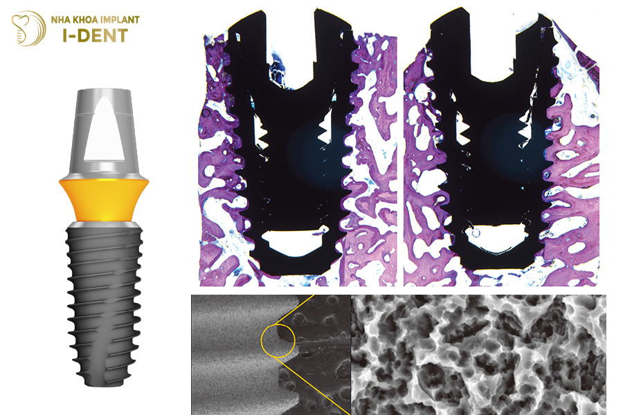 Trụ Implant Mỹ có khả năng tích hợp xương khác nhau Trụ Implant Mỹ có khả năng tích hợp xương khác nhau