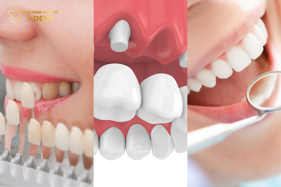 Những trường hợp nào cần phải mài răng? mài răng bọc sứ có ảnh hưởng gì không
