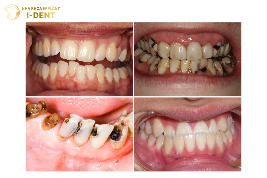 Các trường hợp nên bọc răng sứ hàm trên Các trường hợp nên bọc răng sứ hàm trên