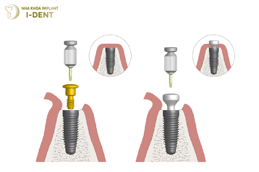 Tuổi thọ Healing Abutment tỉ lệ thuận với trụ Implant Tuổi thọ Healing Abutment tỉ lệ thuận với trụ Implant