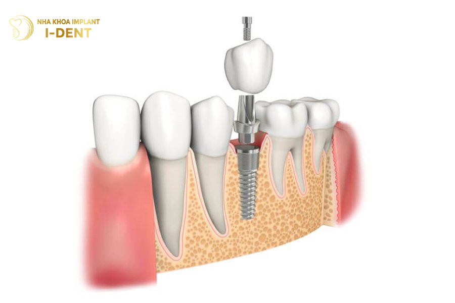 tuổi thọ răng implant trồng răng implant được bao lâu