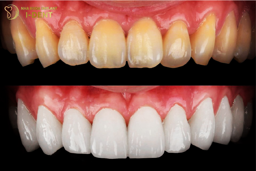 Tuổi thọ sử dụng của mặt sứ lên đến 15 năm Tuổi thọ sử dụng của mặt sứ lên đến 15 năm