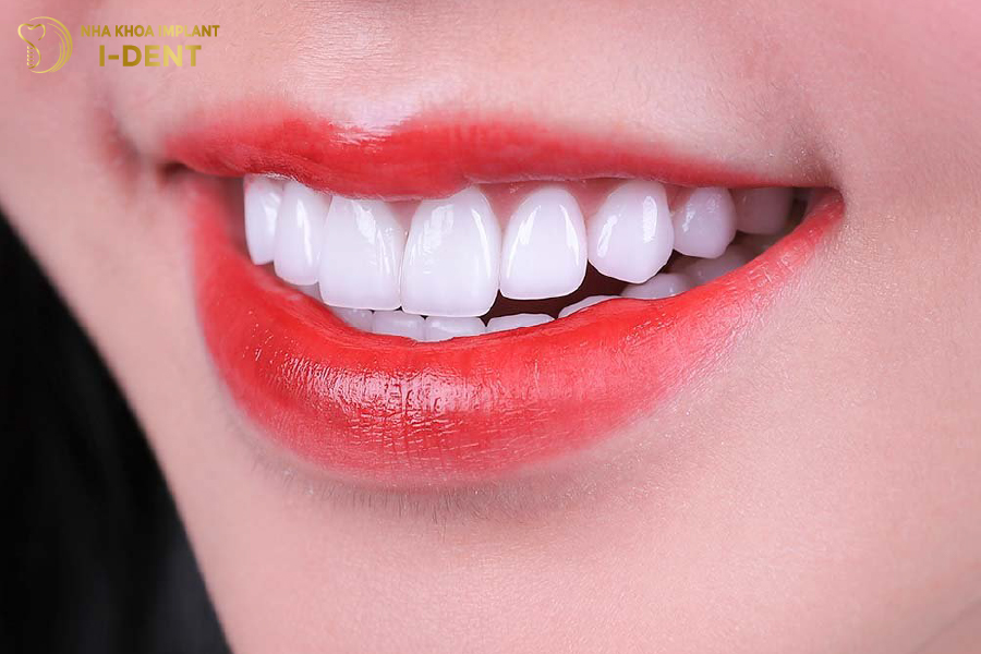 Tuổi thọ trung bình của răng sứ HT Smile là 15 năm Tuổi thọ trung bình của răng sứ HT Smile là 15 năm