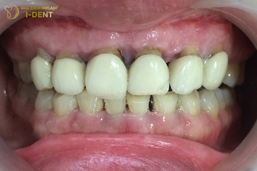 Tụt lợi do vật liệu sứ kém chất lượng sẽ phải thay lại mão sứ mới Bọc sứ bị tụt lợi