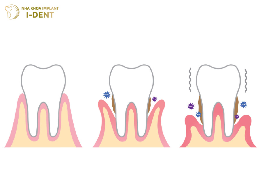 Tụt lợi khiến cho chân răng suy yếu và dễ lung lay Răng sứ bị tụt lợi