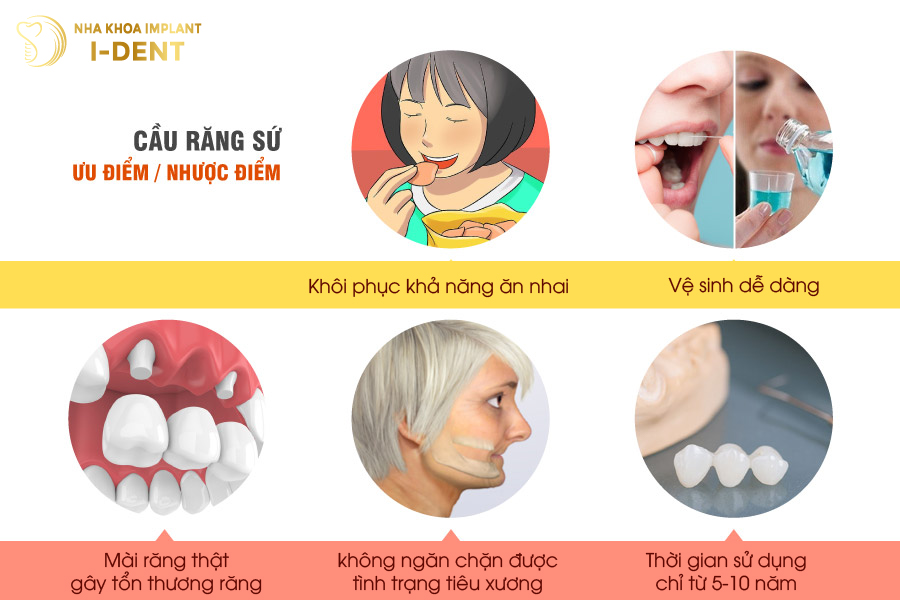 Ưu nhược điểm bắc cầu răng sứ các loại răng giả