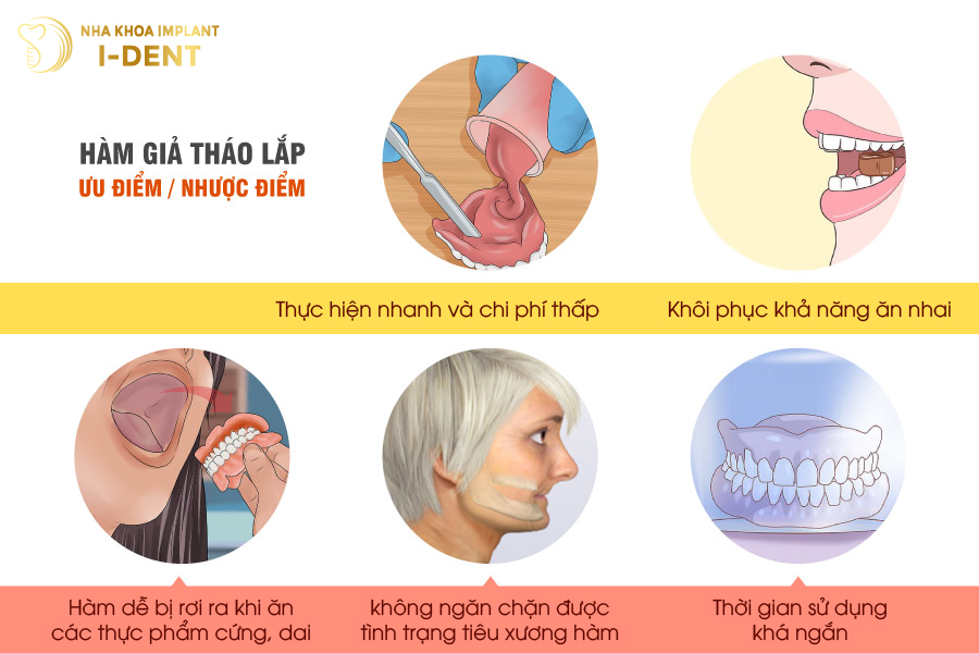 Ưu nhược điểm Hàm giả tháo lắp các loại trồng răng