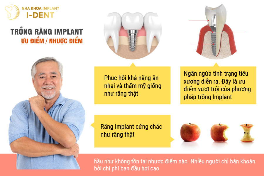 Ưu nhược điểm trồng răng Implant các phương pháp trồng răng
