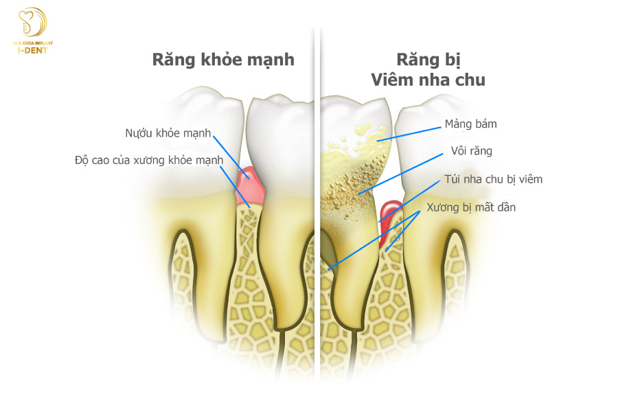 Vì sao răng khểnh lại dễ gây các bệnh lý răng miệng như viêm nha chu? Vì sao răng khểnh lại dễ gây các bệnh lý răng miệng như viêm nha chu?