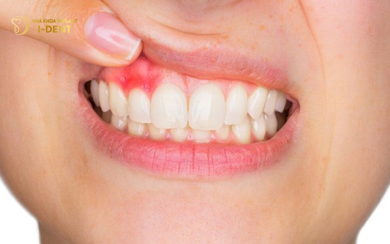 Viêm nướu do bọc răng sứ làm răng sứ có ảnh hưởng gì không
