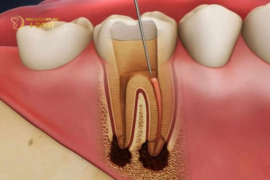 Viêm tủy răng do mài răng không đúng kỹ thuật tác hại bọc răng sứ