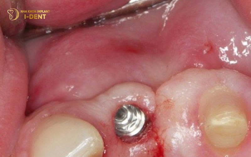 Vùng cấy Implant bị nhiễm trùng hậu quả của việc cắm trụ implant