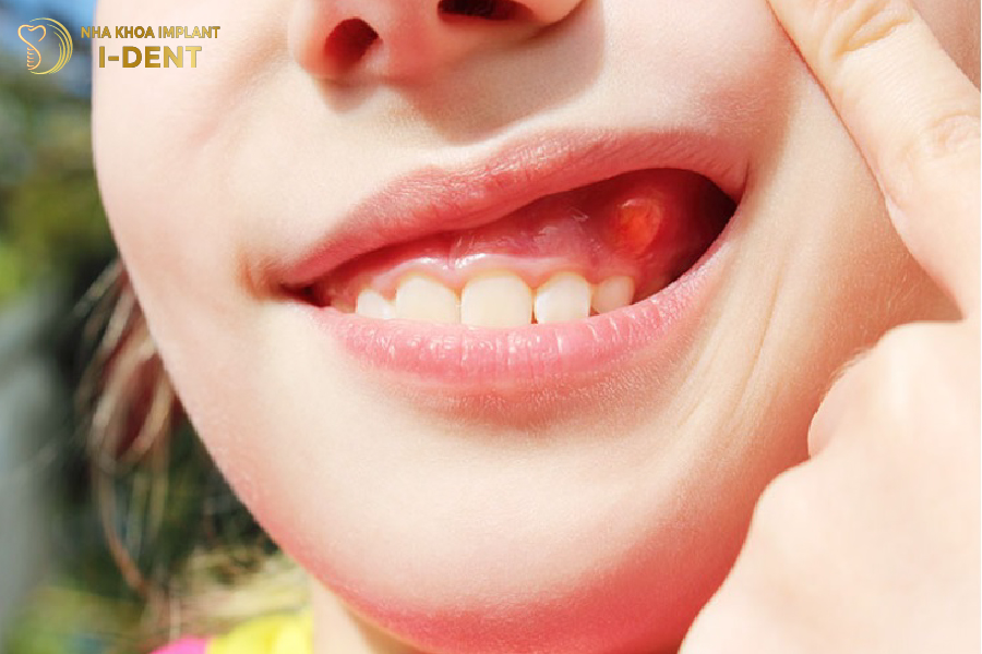 bị nhiễm trùng khi bọc răng sứ