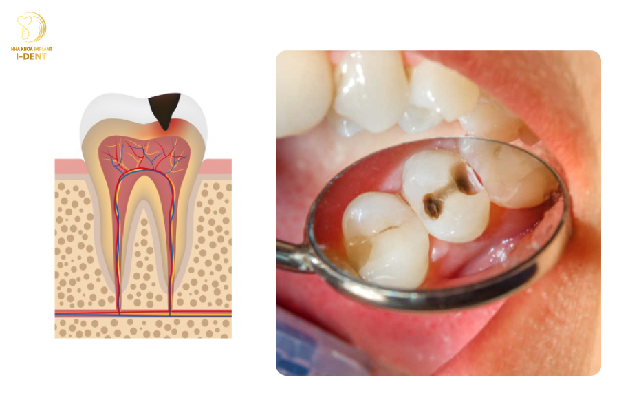 Xuất hiện những lỗ sâu trên răng Xuất hiện những lỗ sâu trên răng