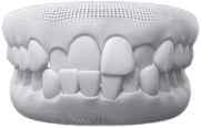 mặt dán sứ veneer