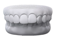 veneer răng