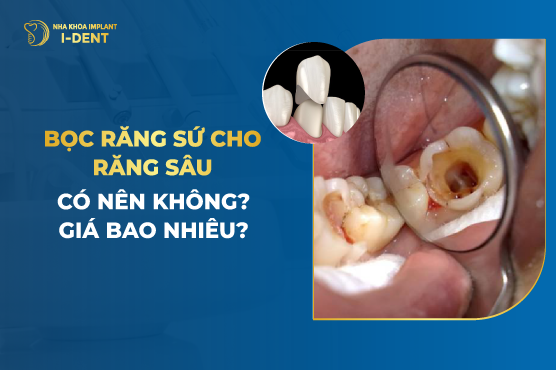 Bọc răng sứ cho răng hàm bị sâu giá bao nhiêu? Quy trình