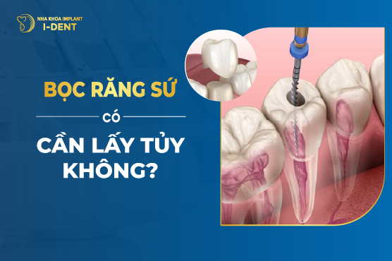 Bọc Răng Sứ Có Cần Lấy Tủy Không?