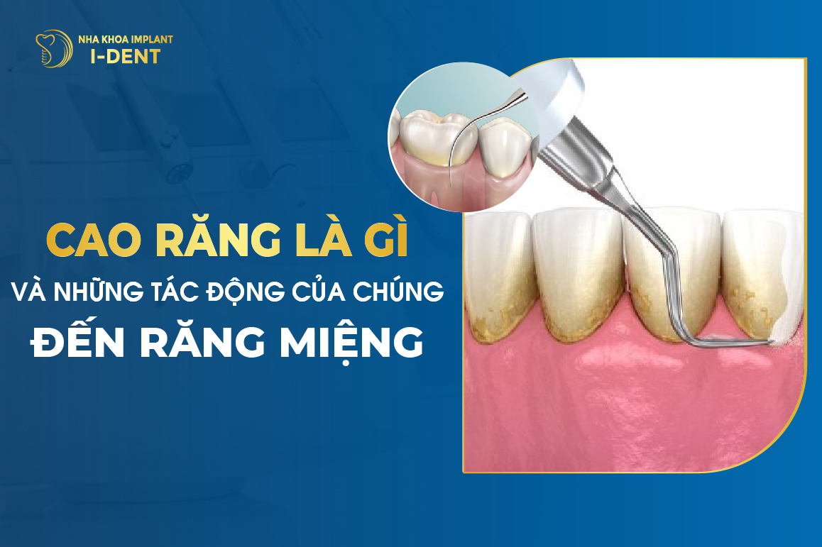 Cao Răng Là Gì Và Những Tác Động Của Chúng Đến Răng Miệng?